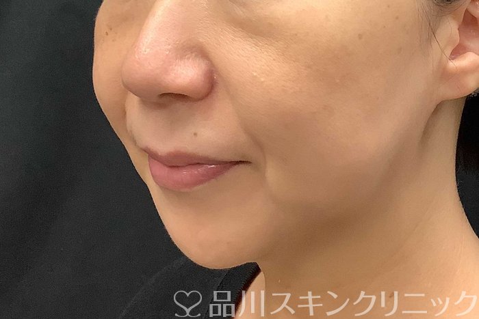 症例NO.69779のBEFORE写真