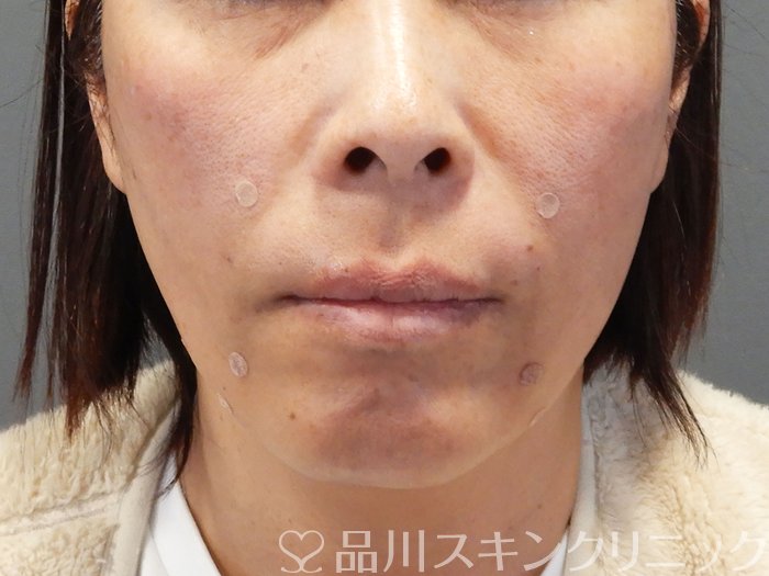 症例NO.69479のAFTER写真