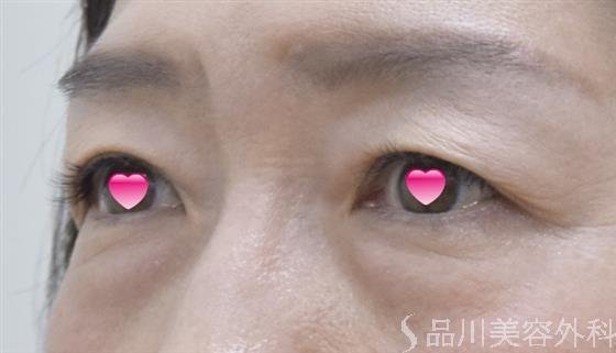 症例NO.52440のBEFORE写真