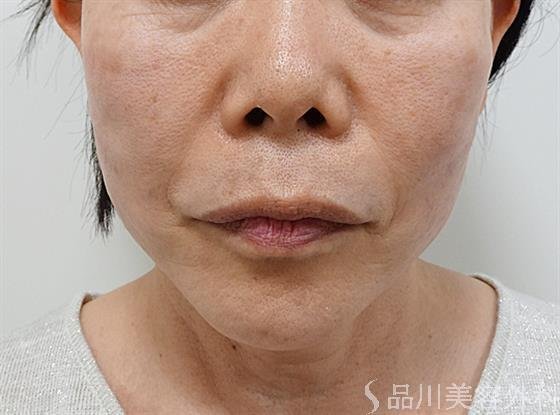 症例NO.55612のAFTER写真