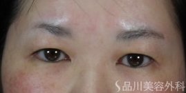 症例NO.74782のBEFORE写真