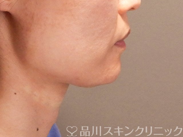 症例NO.70676のAFTER写真