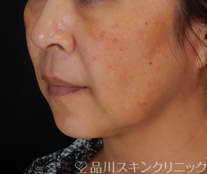 症例NO.66743のBEFORE写真