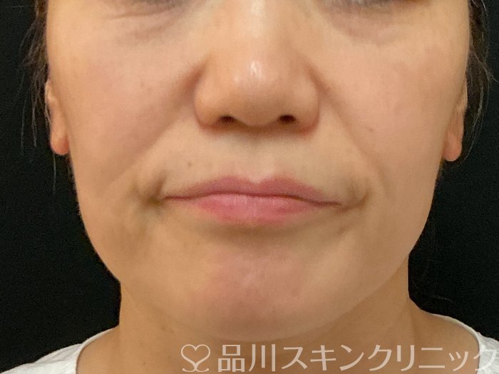 症例NO.74147のBEFORE写真