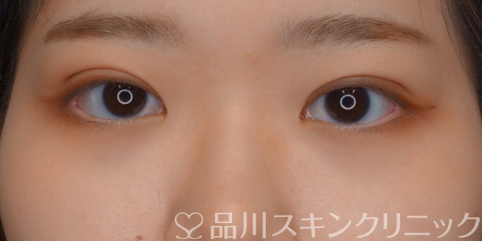 症例NO.73157のAFTER写真