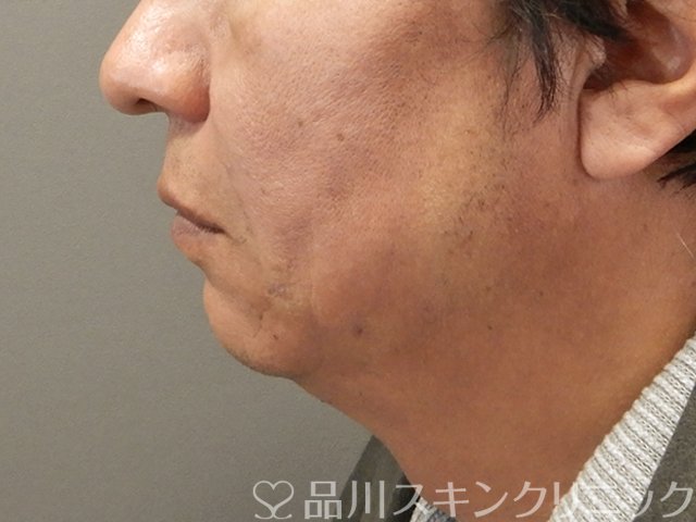 症例NO.75134のAFTER写真