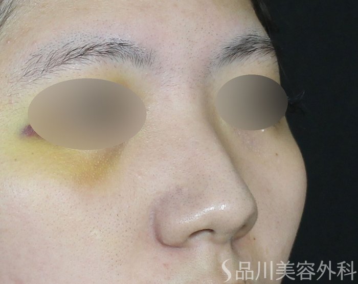 症例NO.71221のBEFORE写真