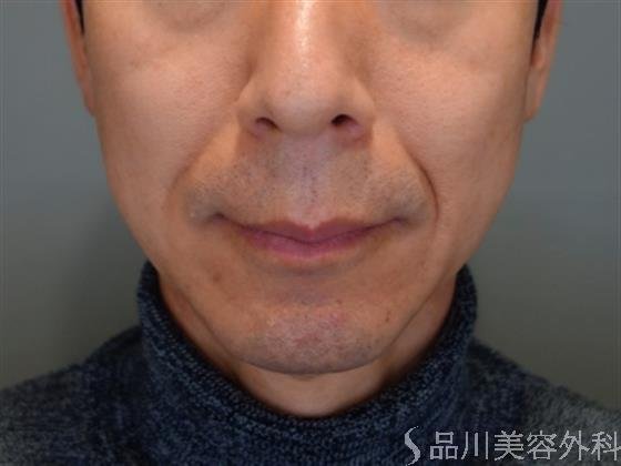 症例NO.49784のBEFORE写真