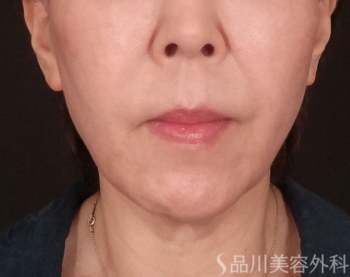 症例NO.70341のAFTER写真