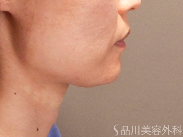 症例NO.70676のAFTER写真
