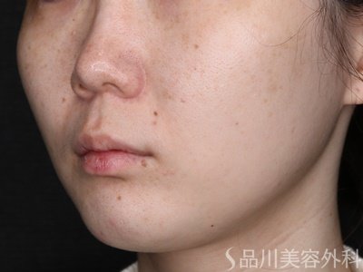 症例NO.72672のAFTER写真