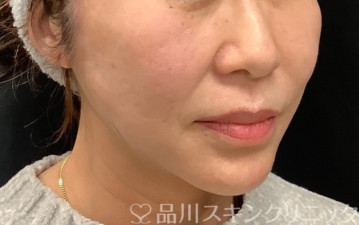 症例NO.67964のAFTER写真