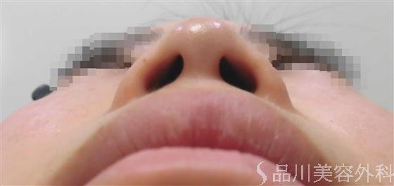 症例NO.33535のBEFORE写真