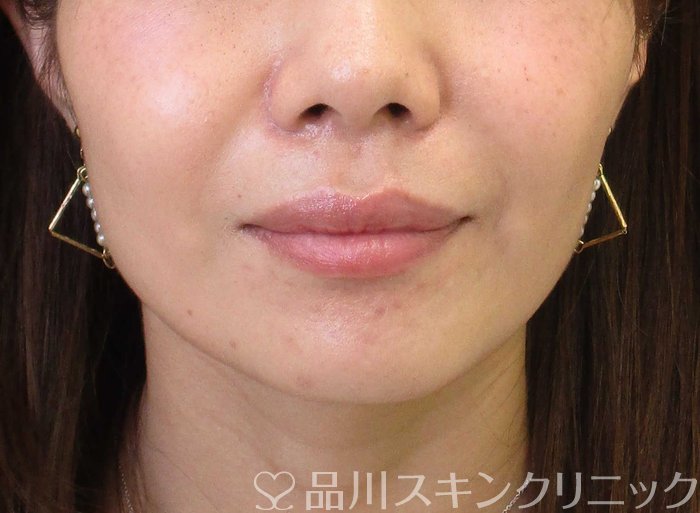 症例NO.65418のBEFORE写真