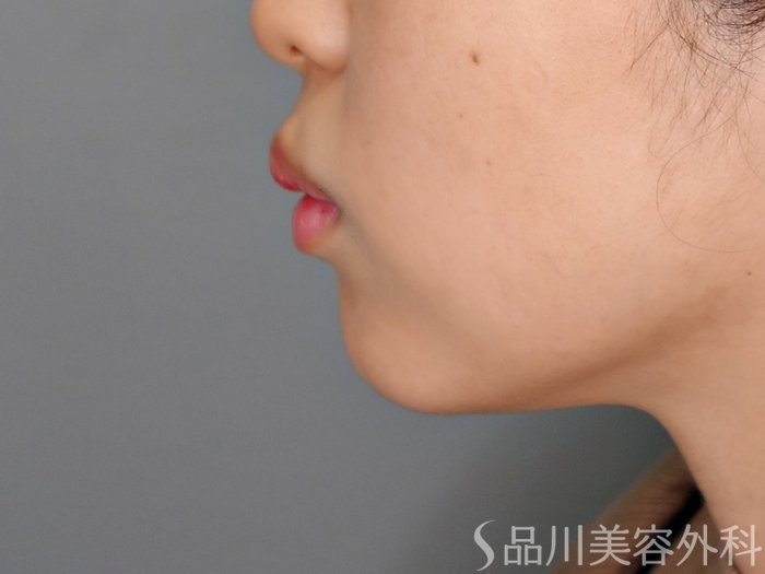 症例NO.69950のBEFORE写真