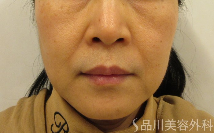 症例NO.73642のBEFORE写真