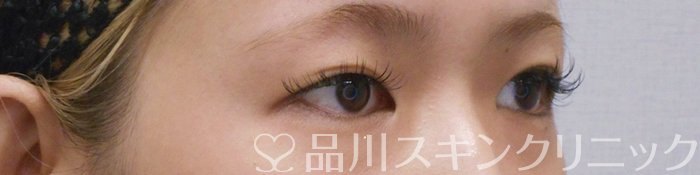 症例NO.75163のBEFORE写真