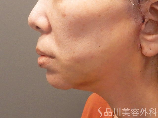 症例NO.72187のAFTER写真