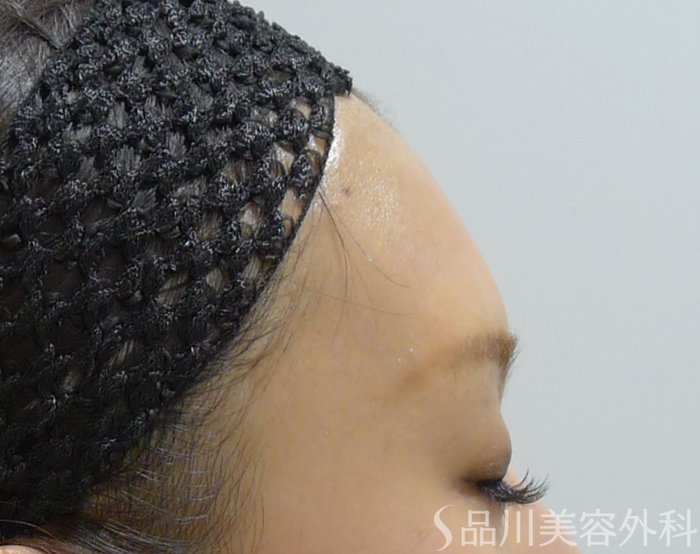 症例NO.70575のBEFORE写真