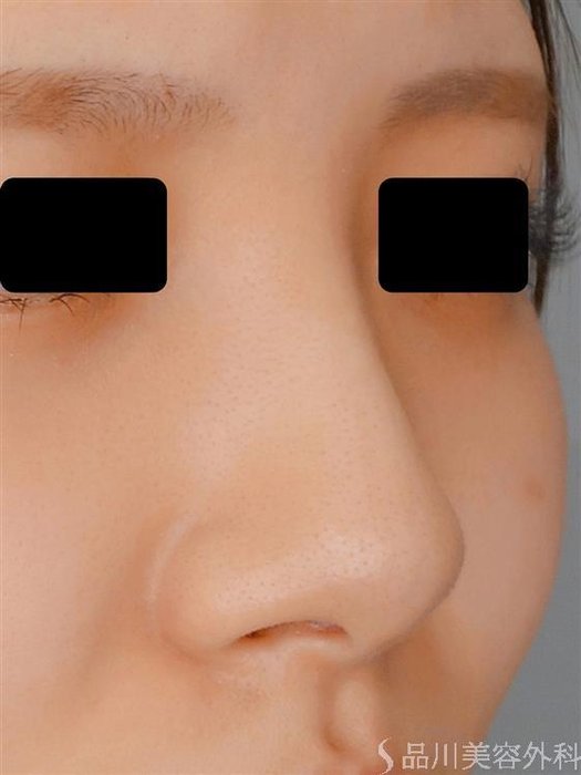 症例NO.55012のBEFORE写真