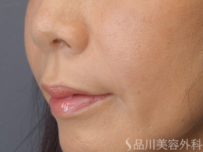 症例NO.72111のAFTER写真