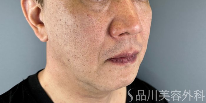 症例NO.65651のBEFORE写真