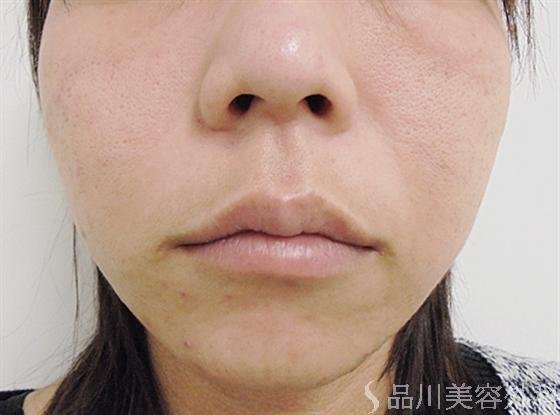 症例NO.16776のAFTER写真