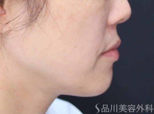 症例NO.69603のBEFORE写真