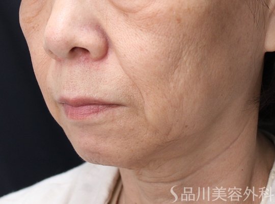 症例NO.71052のBEFORE写真