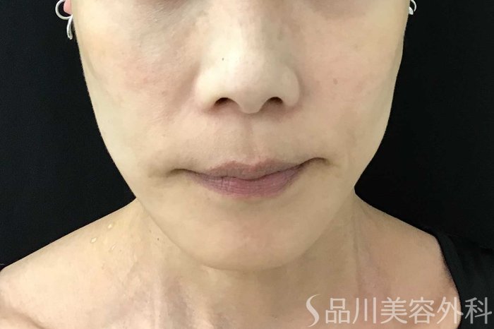 症例NO.71108のAFTER写真