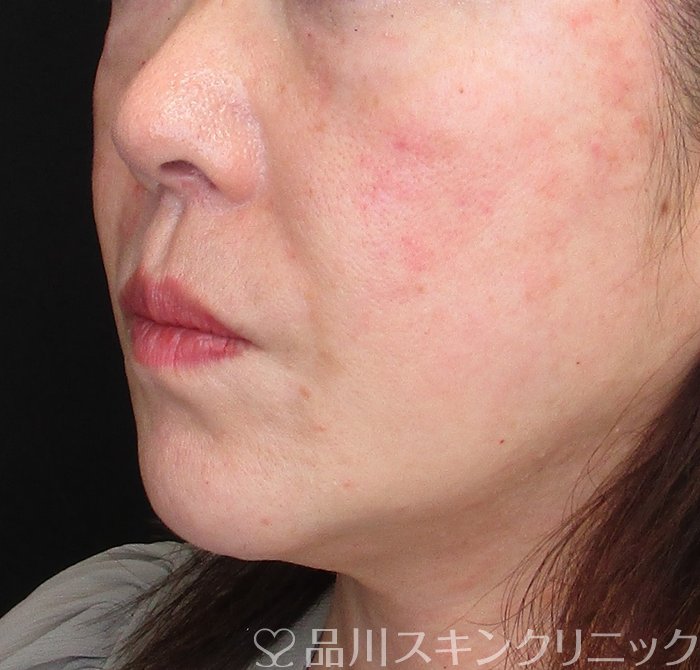 症例NO.73159のAFTER写真