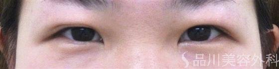 症例NO.10350のBEFORE写真