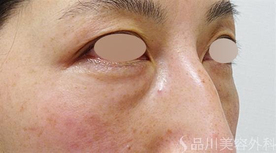症例NO.50882のBEFORE写真