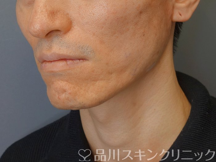 症例NO.72817のAFTER写真