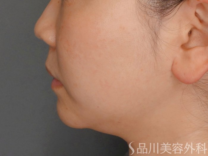 症例NO.74329のBEFORE写真