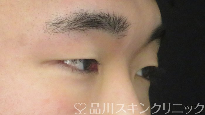 症例NO.69553のBEFORE写真