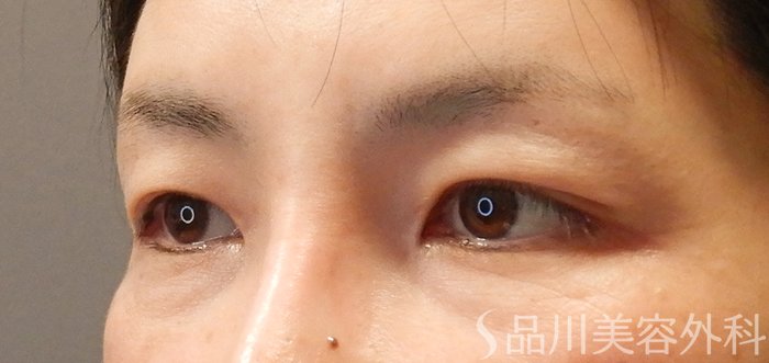 症例NO.67762のBEFORE写真