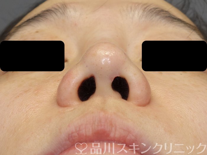 症例NO.72366のAFTER写真