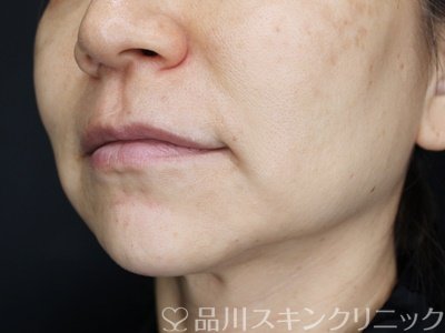 症例NO.70380のAFTER写真