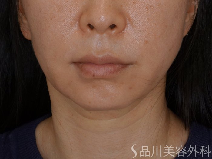 症例NO.74455のBEFORE写真