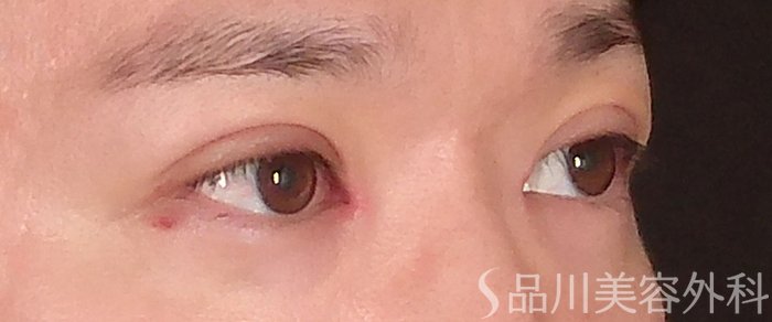 症例NO.72896のAFTER写真