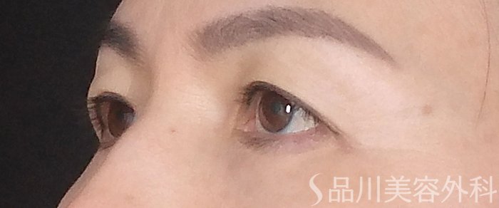 症例NO.68006のBEFORE写真