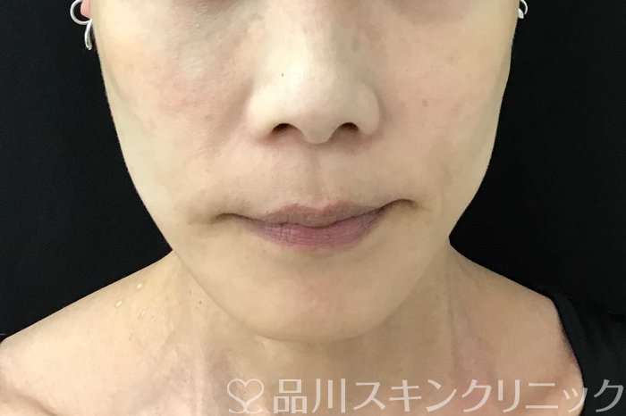 症例NO.71108のAFTER写真