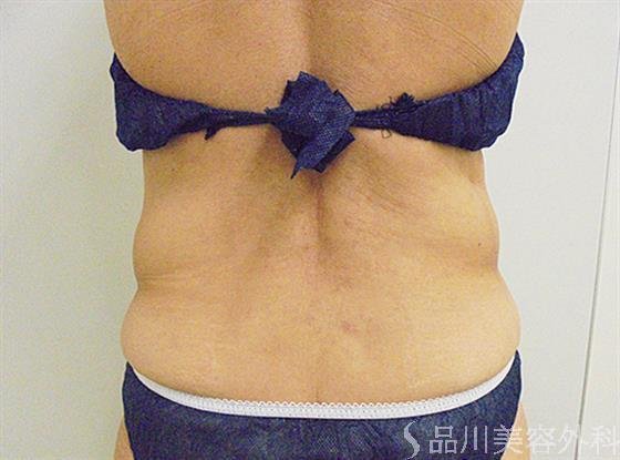 症例NO.22255のAFTER写真