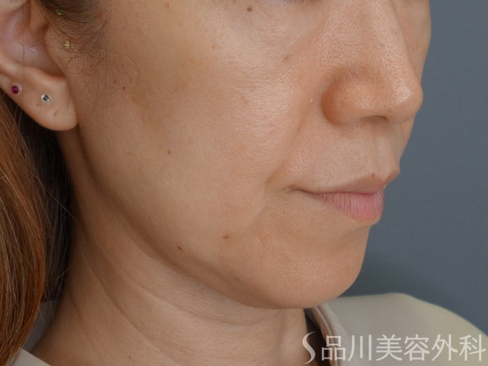 症例NO.74496のBEFORE写真