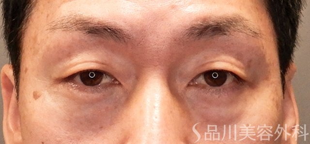 症例NO.70550のBEFORE写真