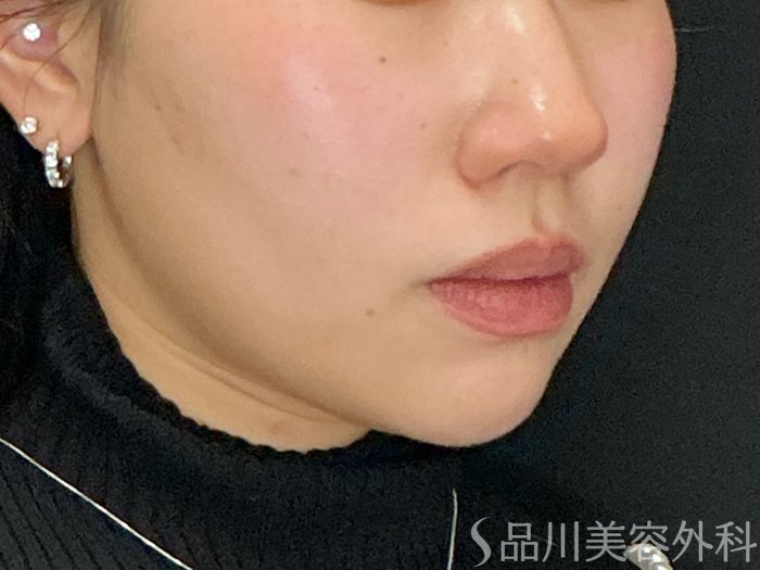 症例NO.72916のBEFORE写真