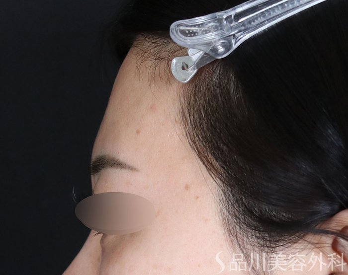 症例NO.72712のBEFORE写真