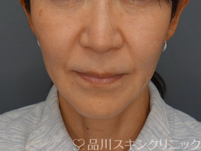 症例NO.74314のBEFORE写真