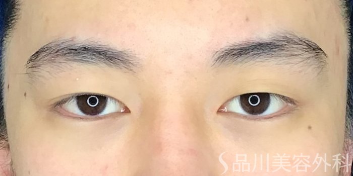 症例NO.69743のBEFORE写真